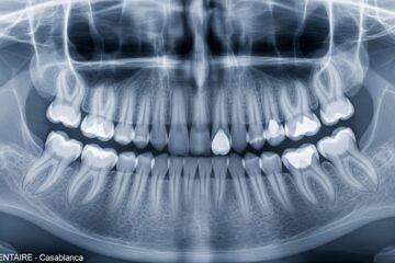 Radiographie Rétro-Alvéolaire : Tout Ce Que Vous Devez Savoir (Prix, Déroulement, Sécurité)