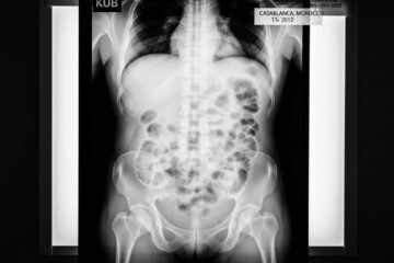 Radiographie de l’Abdomen Sans Préparation au Maroc : Guide Complet pour Patients