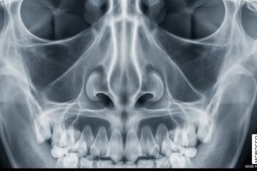 Radiographie des Os Propres du Nez au Maroc : Prix, Déroulement et Tout ce qu’il Faut Savoir