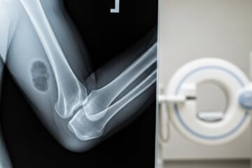 Radiographie du Coude au Maroc : Guide Complet pour Patients