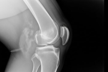 Radiographie du Genou au Maroc : Guide Complet (Prix, Procédure & Résultats)