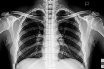 Radiographie du Sternum au Maroc : Prix, Remboursement AMO et Déroulement Complet